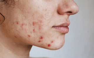 Hormonal-acne Theranera