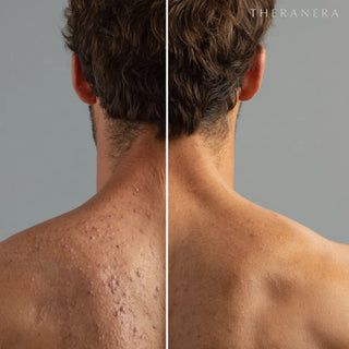 Acne Soap Bar Theranera