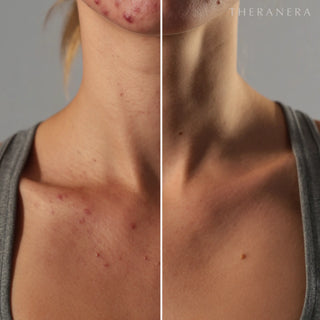 Acne Soap Bar Theranera